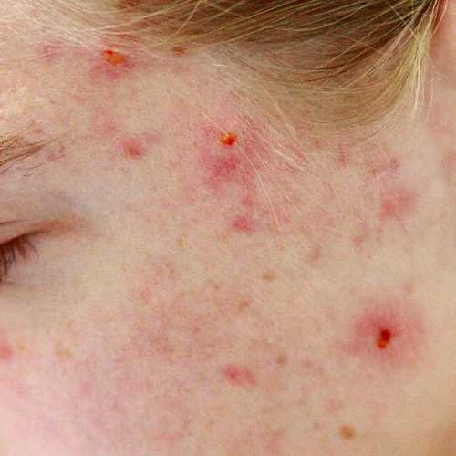 highcompress_acne.png highcompress_acne.png