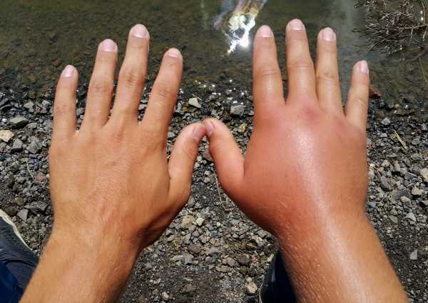 one swollen arm following an allergic reaction