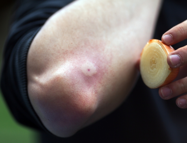 using a piece of onion to help soothe a sting on an arm