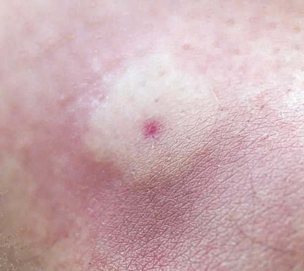 a sting on human skin