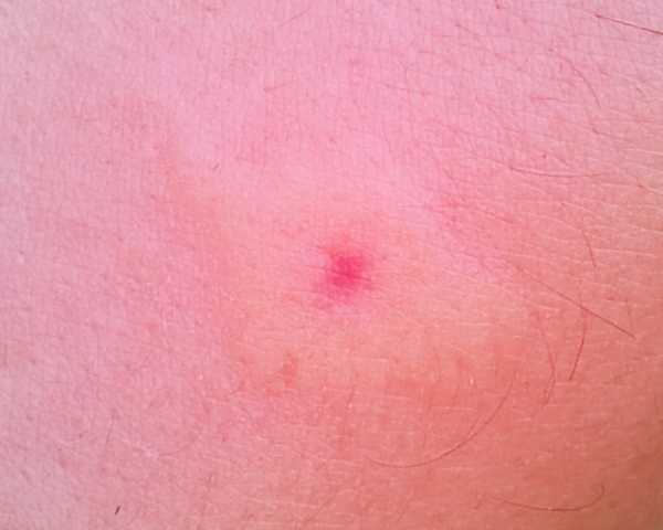 a sting showing a pinkish skin reaction